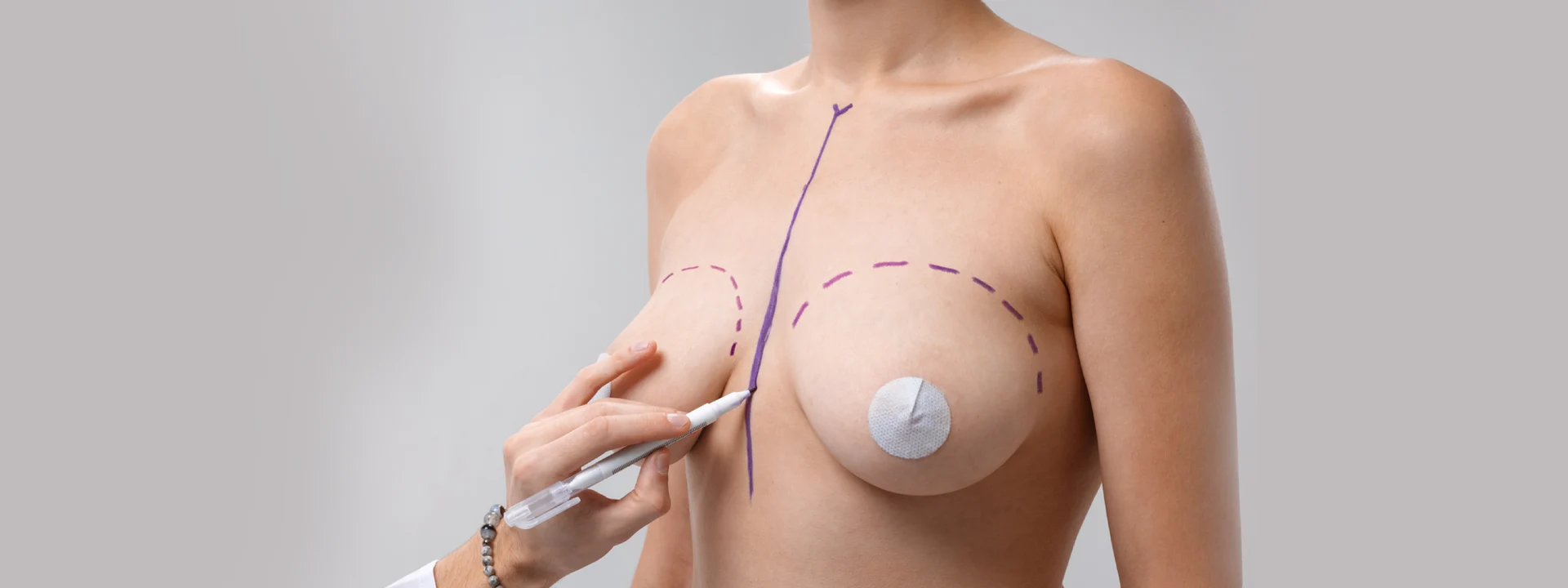 What Is Breast Reduction Surgery?