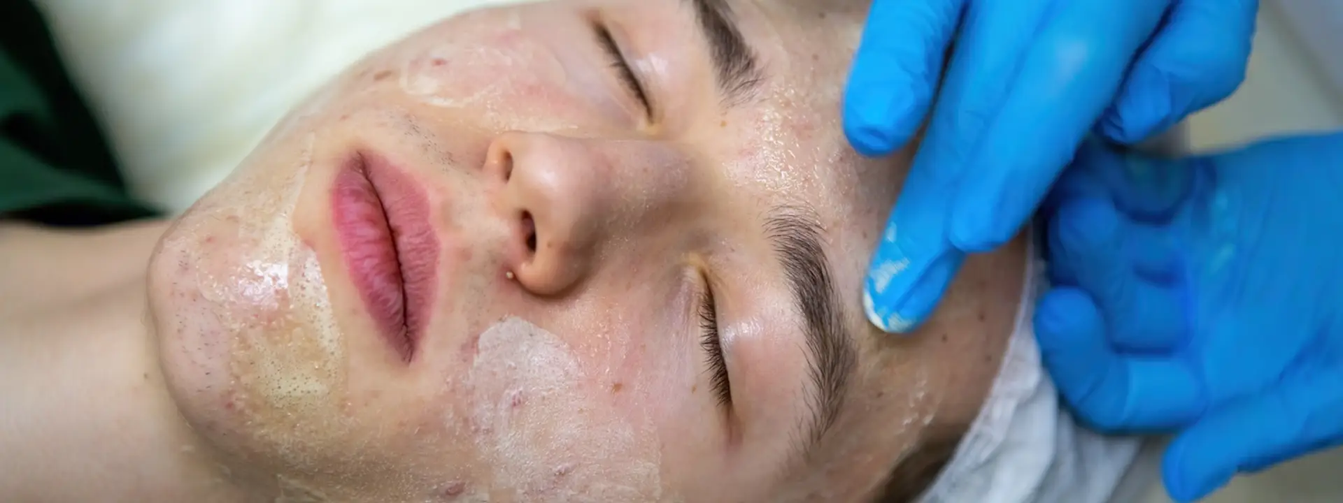 What Is Chemical Peeling and How Does It Work?