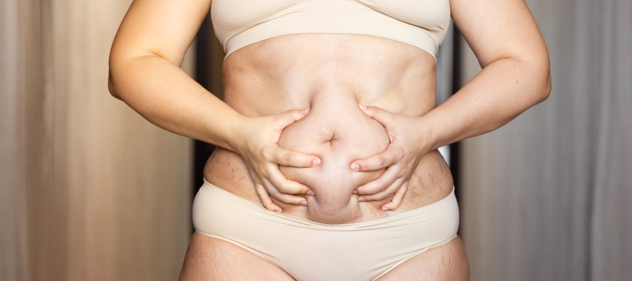 Tummy Tuck Surgery | Plastic Surgery Indian Tummy Tuck Surgery | Plastic Surgery Indian