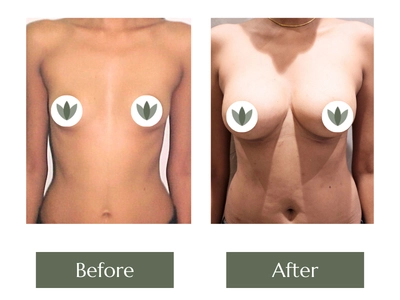 Breast Surgery Breast Surgery