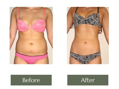 Liposuction Liposuction