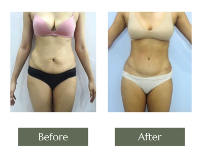 Tummy Tuck Surgery Tummy Tuck Surgery