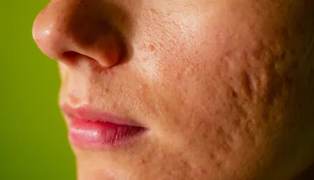 Acne Scars