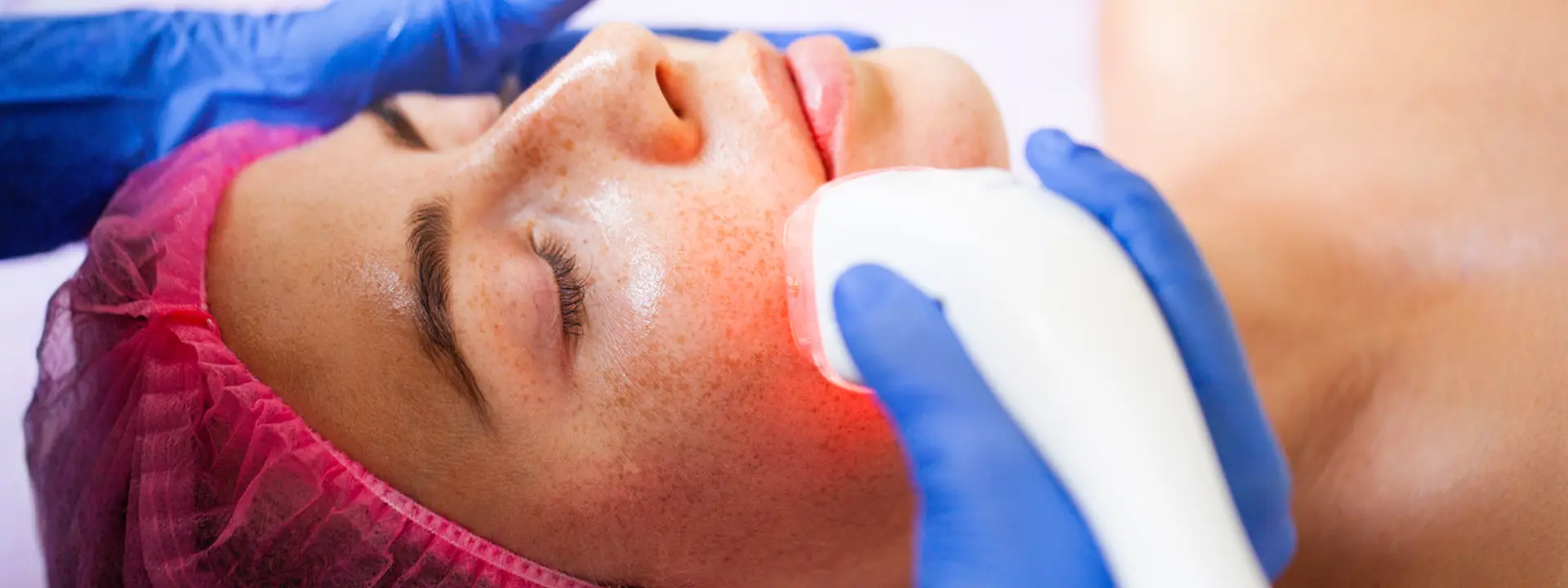 What Is Laser Skin Resurfacing?