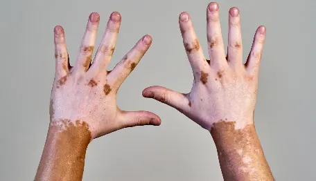 Vitiligo and Psoriasis