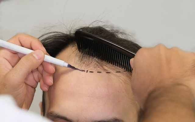 hair transplant