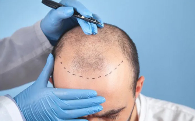 Truth About Pain During Hair Transplant