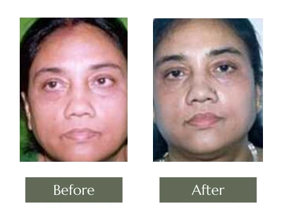 Eye & Lip Surgery, Dr. Manoj Khanna Eye & Lip Surgery, Dr. Manoj Khanna