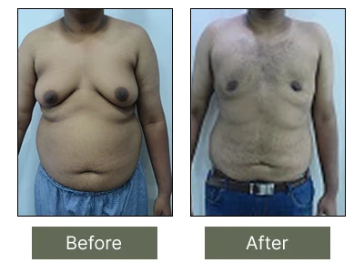 Male Breast Reduction Male Breast Reduction