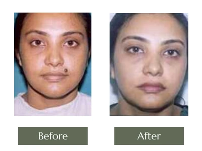 Scar & Mole Removal, Dr. Manoj Khanna Scar & Mole Removal, Dr. Manoj Khanna