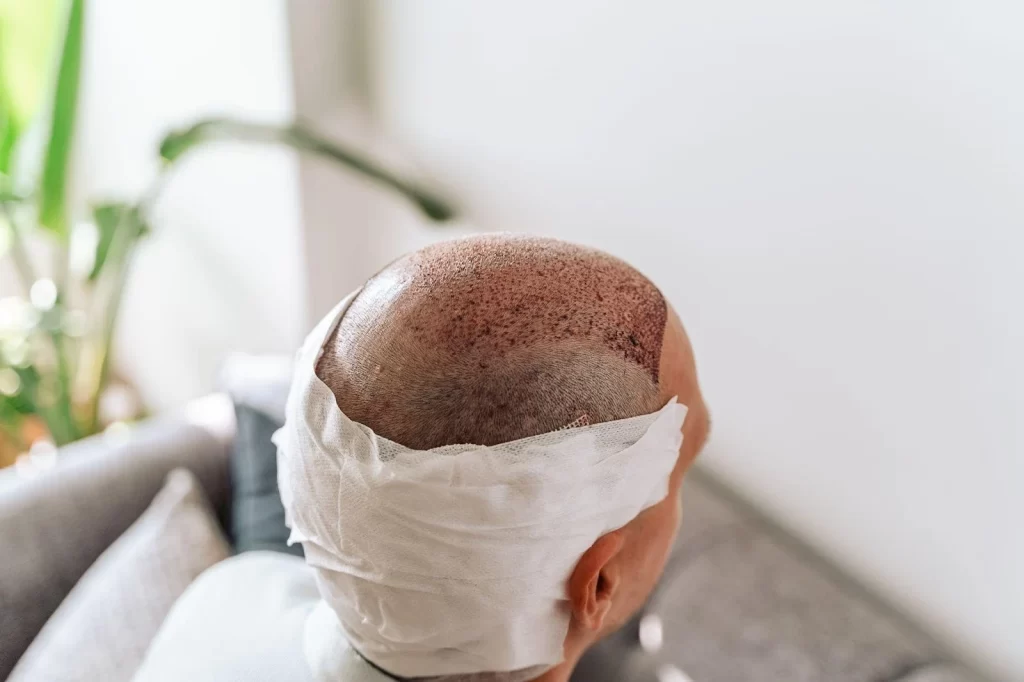 Hair Transplant Recovery Timeline