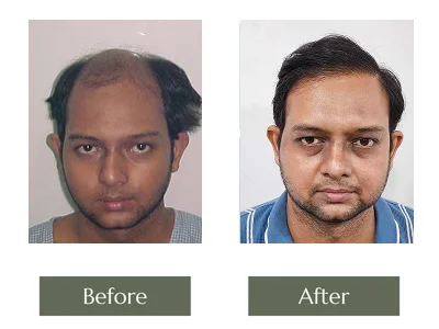 Hair Transplant Hair Transplant