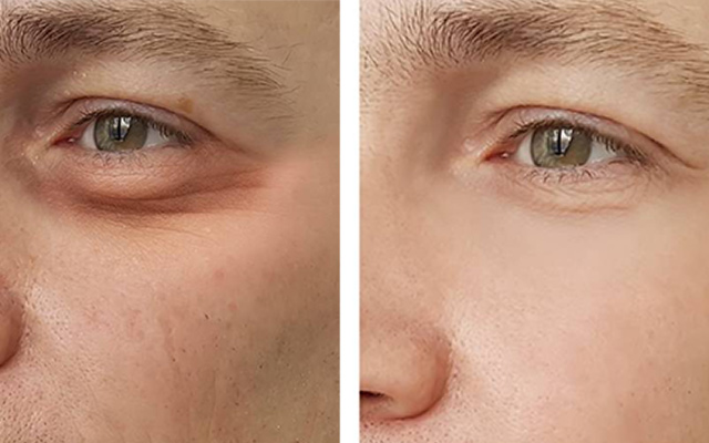 eyelid surgery