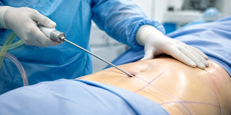 Liposuction Treatment