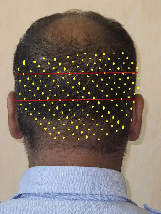 Types of Hair Transplant Scars