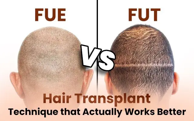fue-vs-fut-hair-transplant-technique-that-actually-works-better