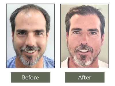 CG Hair Transplant CG Hair Transplant