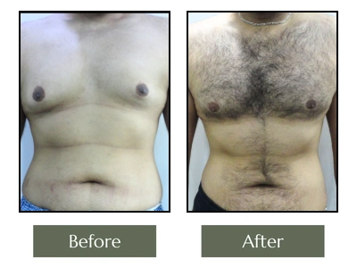 Male Breast Reduction