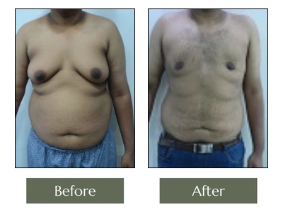 Male Breast Reduction