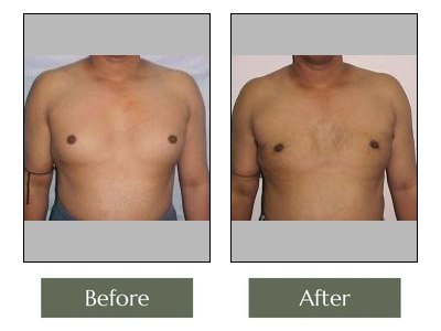 Male Breast Reduction
