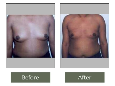 Male Breast Reduction
