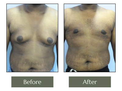 Male Breast Reduction