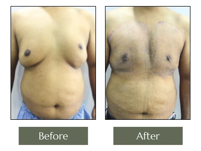 KM Gynecomastia Front View KM Gynecomastia Front View