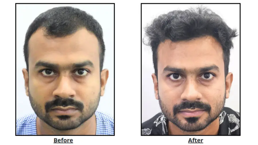 Natural Hairline After Hair Transplant: What Makes the Difference?