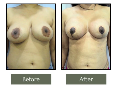 Breast Enlargement Surgery