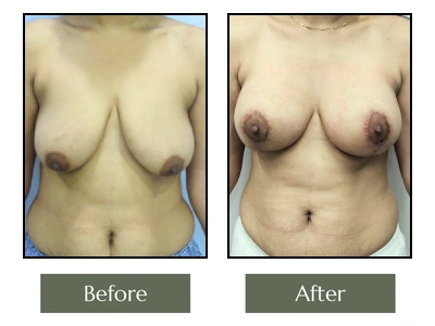 Breast Enlargement Surgery