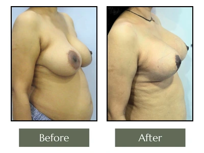 RB Breast Enlargement with Lift Right Side View RB Breast Enlargement with Lift Right Side View