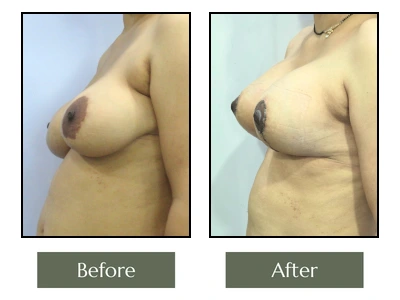 Breast Enlargement Surgery
