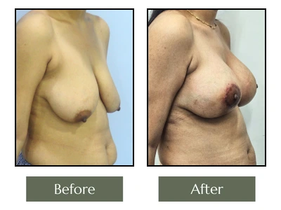 Breast Enlargement Surgery