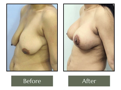 SK Breast Enlargement with Lift Left Side View