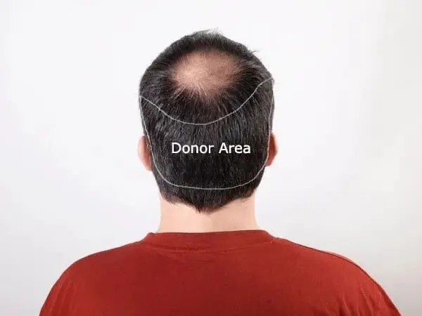Understanding the Donor Area