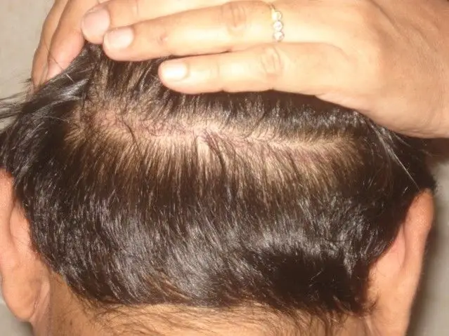 FUE (Follicular Unit Extraction) Scars
