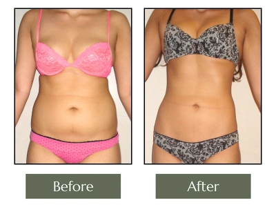 Liposuction