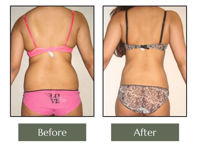 SJ Liposuction Back View SJ Liposuction Back View