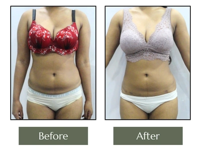 Liposuction