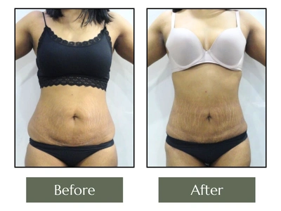 Liposuction
