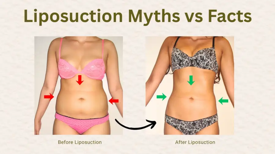 Liposuction Myths vs Facts