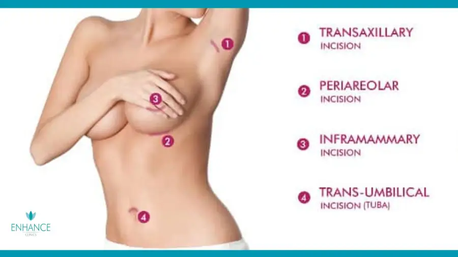 Scar of Breast Enlargement: What to Expect and How to Minimise It