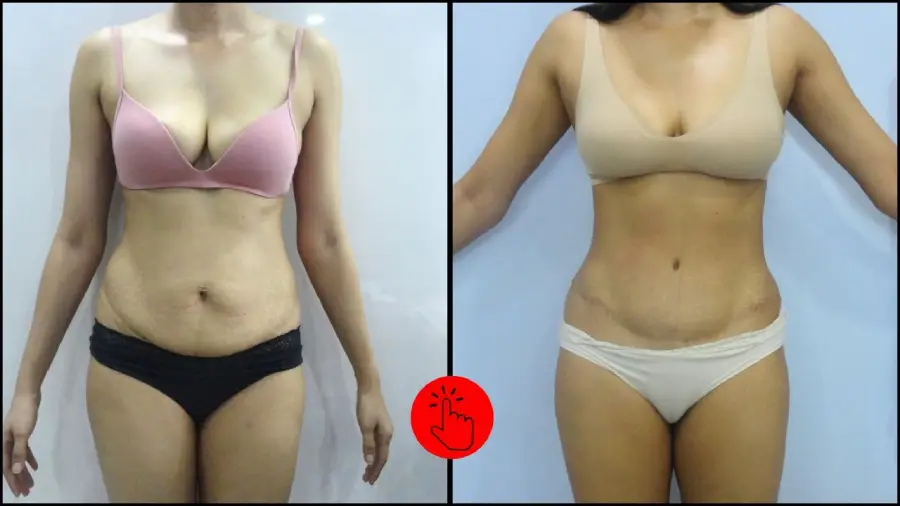 10 Things You Should Know Before Getting a Tummy Tuck Surgery