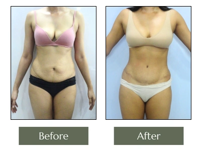 Tummy Tuck