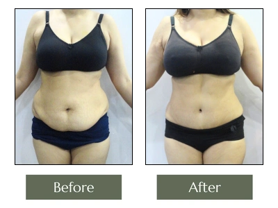 Tummy Tuck