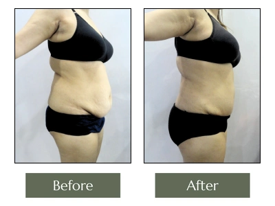 ZK Tummy Tuck Right Side View ZK Tummy Tuck Right Side View