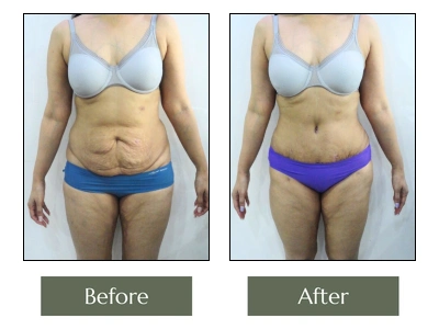 Tummy Tuck