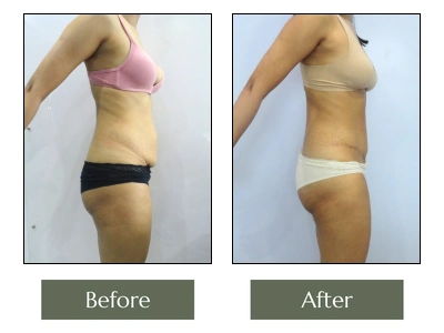 SS Tummy Tuck Right Side View SS Tummy Tuck Right Side View