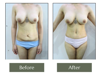 SG Tummy Tuck Front View SG Tummy Tuck Front View