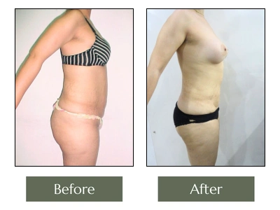 Tummy Tuck